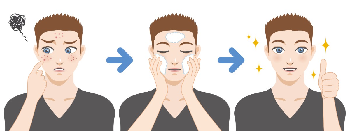 Benzoyl Peroxide, Accutane vs. Salicylic Acid
