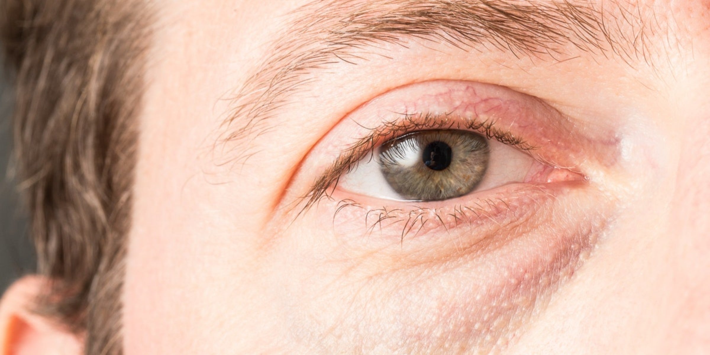 What helps with bags under discount eyes