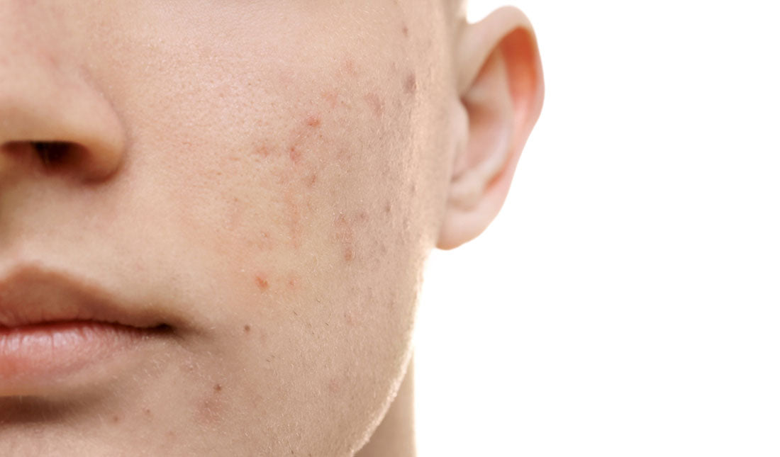 How to Get Rid of Acne Scars: Proven Tips for Clear Skin Fast