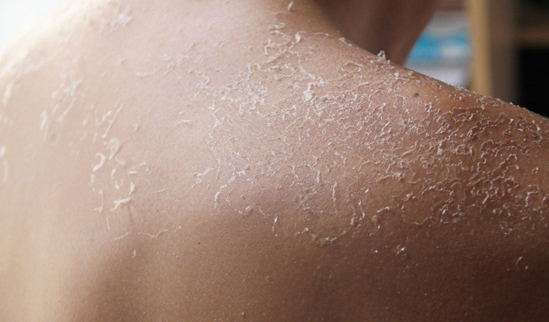dry peeling skin on back