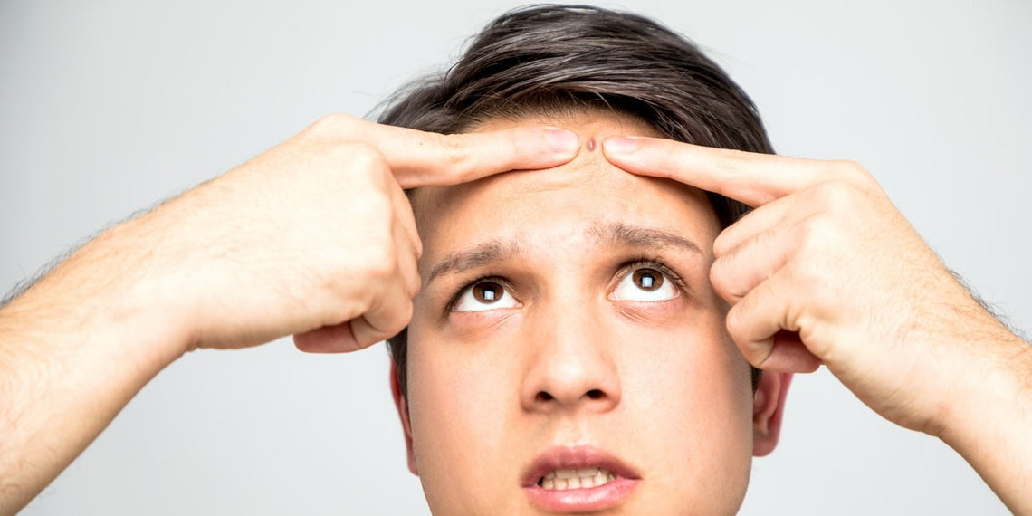 10 Ways to Prevent Acne