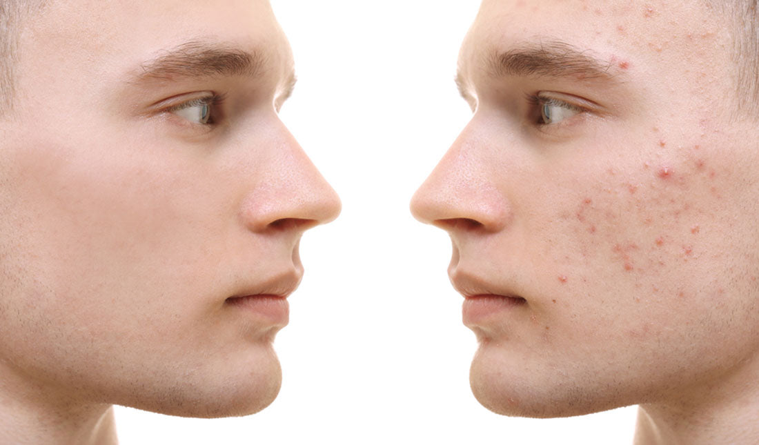 Accutane ohne pille