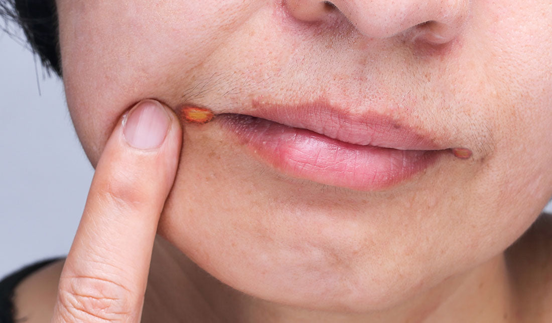 Herpes On Corner Of Lip