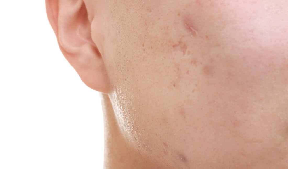 closeup facial acne scars