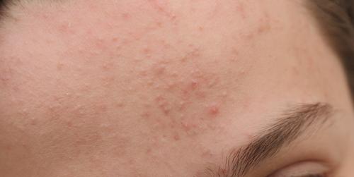 subclinical acne on forehead