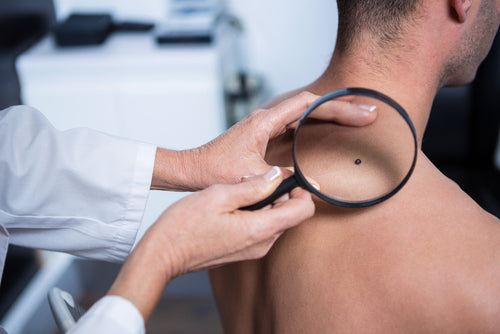 dermatologist examining mole on mans back