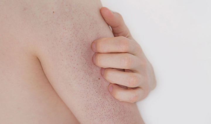 How to Get Rid of Bumps on Arms – Tiege Hanley