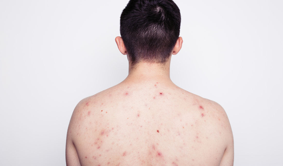 guy showing back acne