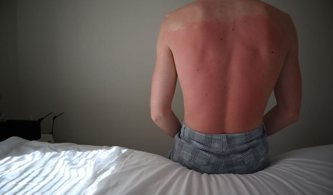 man with inflamed red skin on back