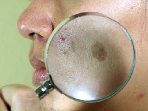 melasma magnified on face