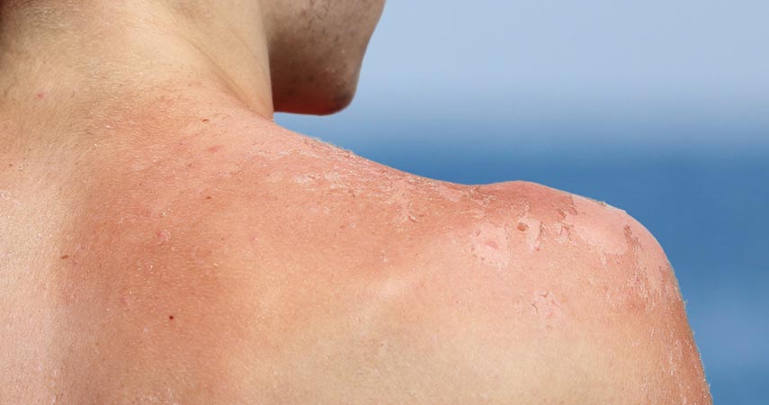 shoulders peeling from sunburn