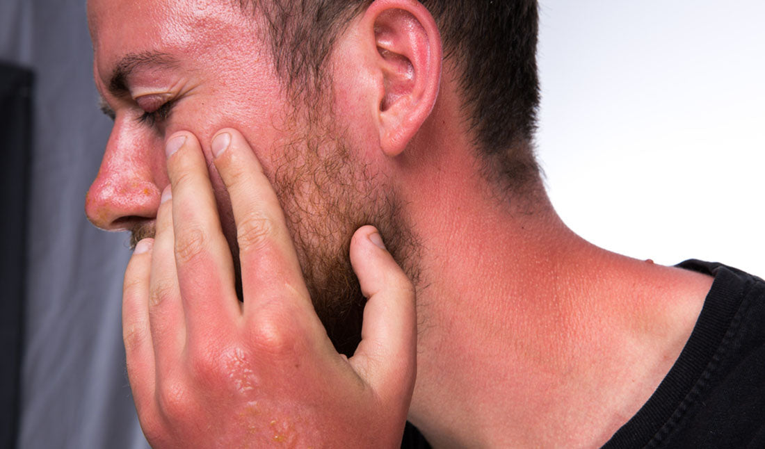 Second Degree Sunburn What Is It And How To Avoid It Tiege Hanley Second degree sunburn what is it and how to avoid it tiege hanley