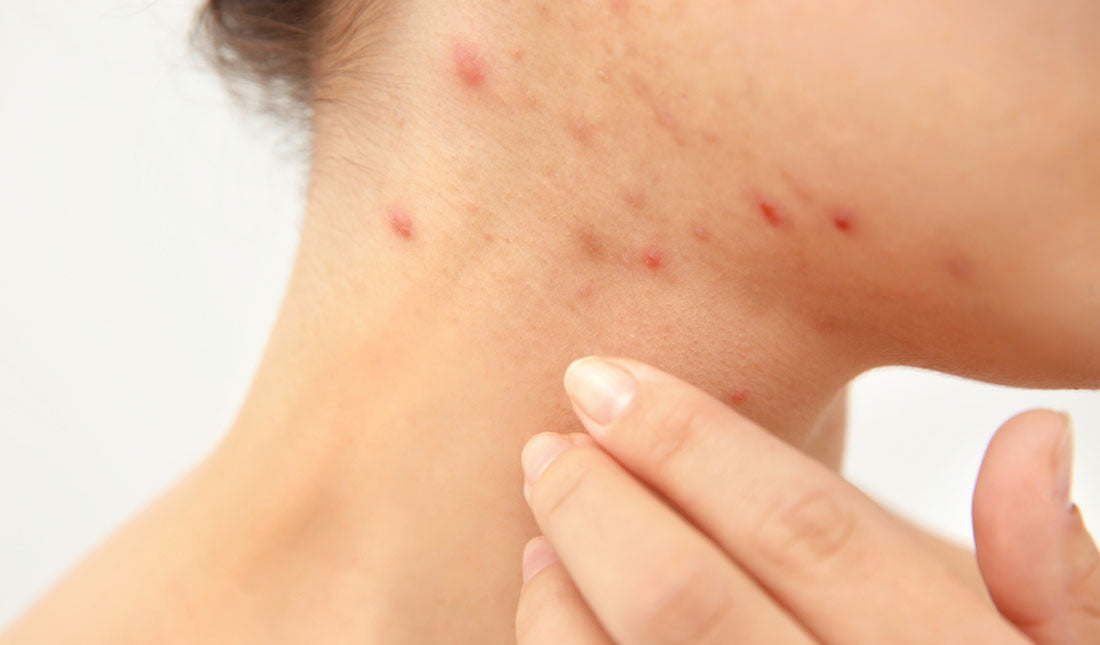 woman with acne on neck