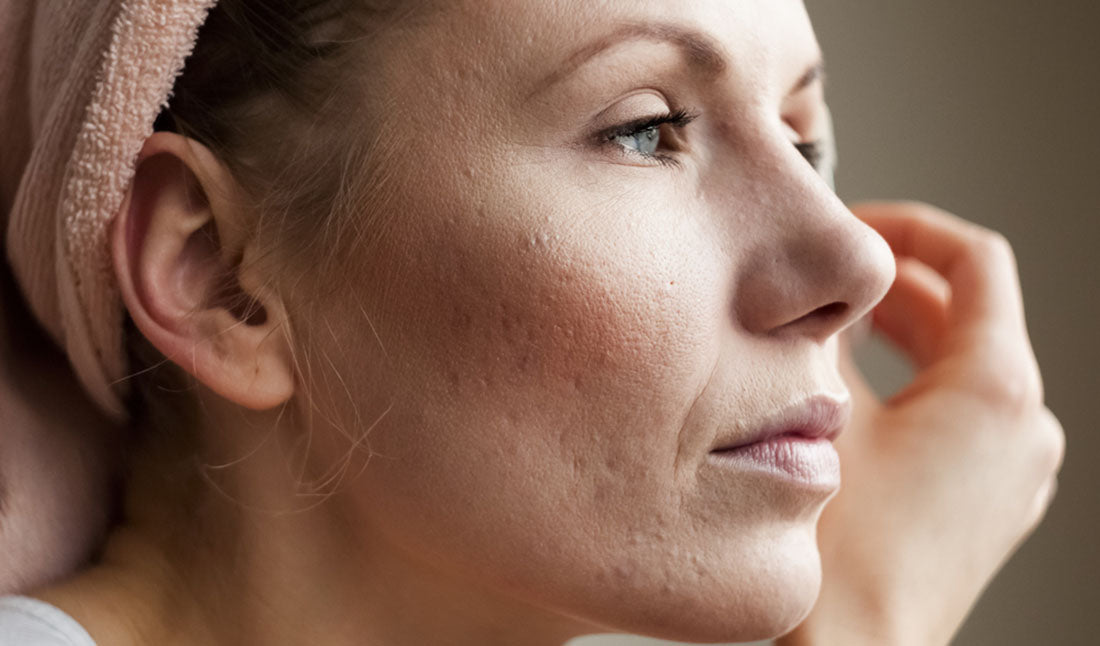 woman with acne scars on cheek