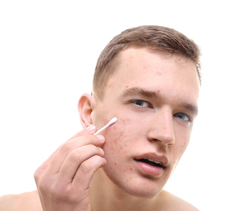 young man with problem skin