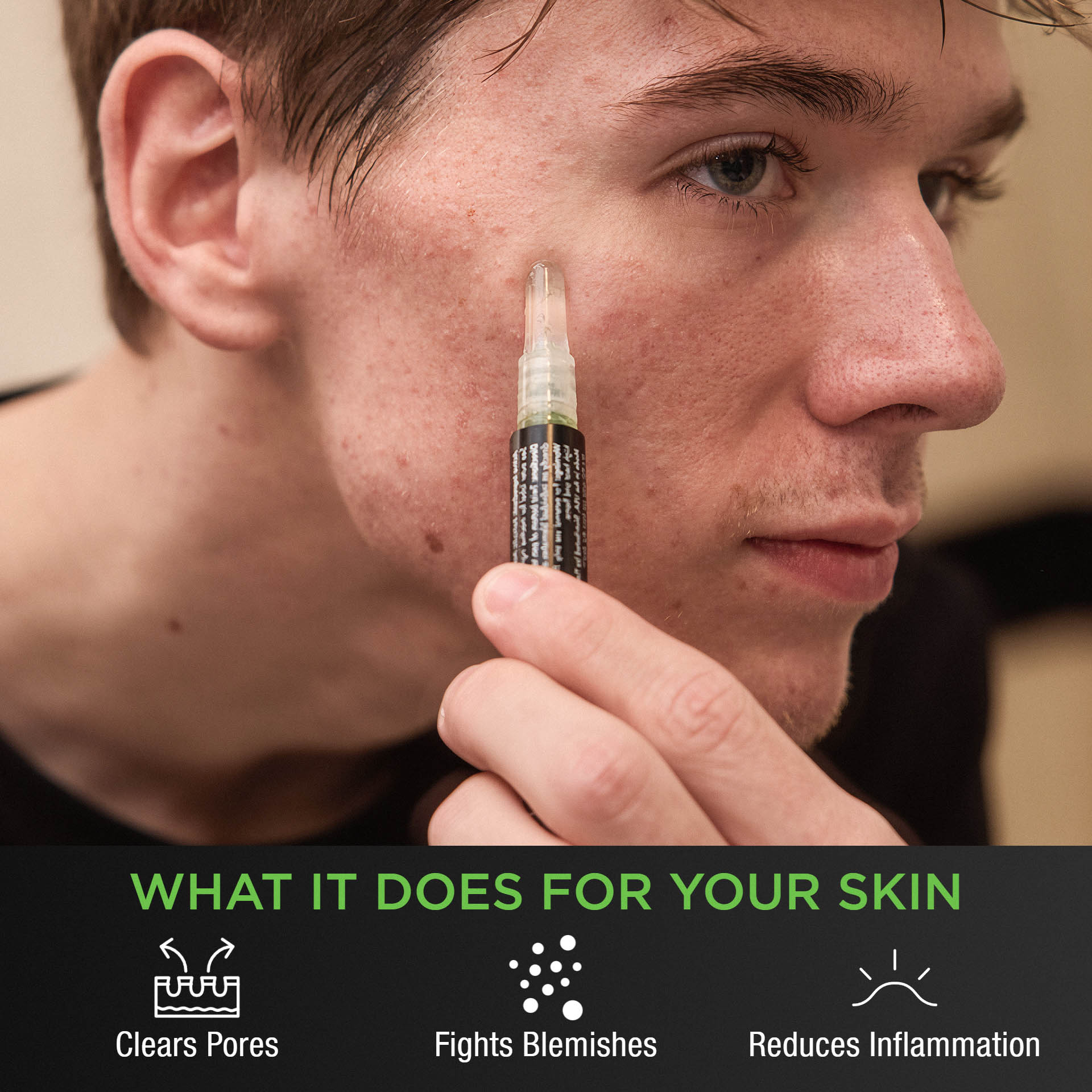 Acne Gel Pen 30 day supply